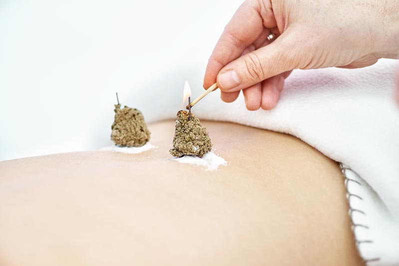 What Is Moxa Acupuncture? This Is The Best Acupuncture Therapy That I’ve Ever Gotten