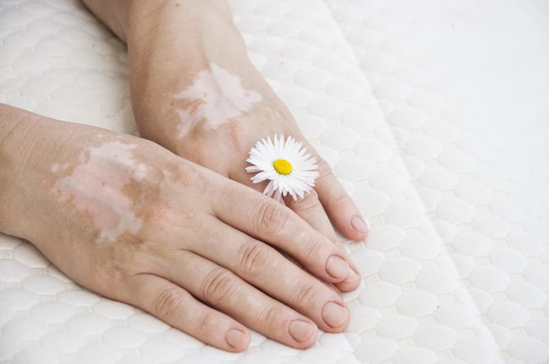 Learn To Use These 6 Acupressure Points For White Patches According To TCM Practitioners