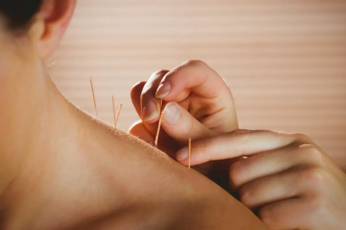Anjuna-Acupuncture-Massage