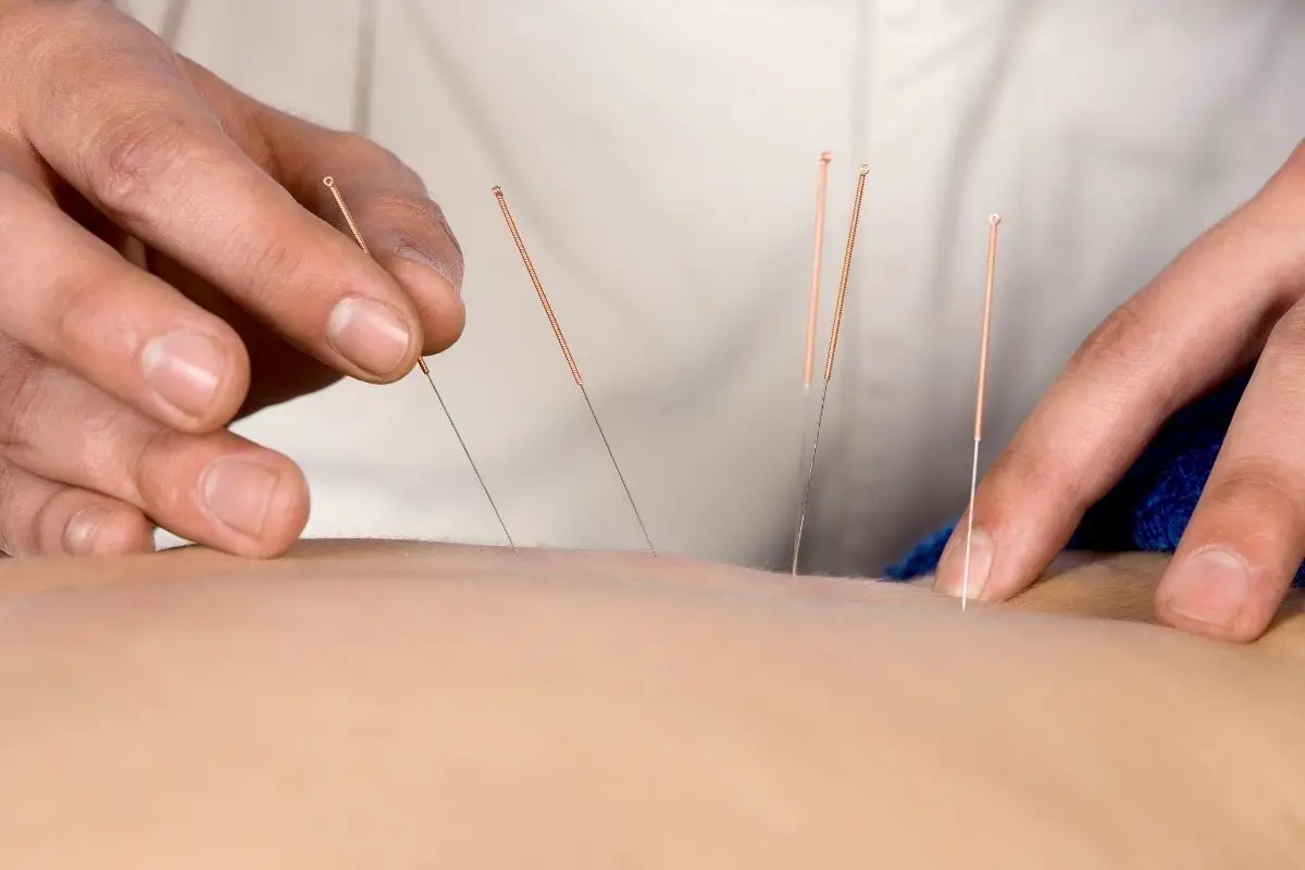 The 6 Best Acupuncture Clinics In Green Bay, WI